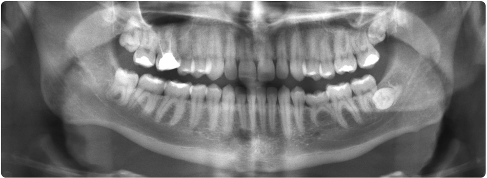 Digital X-Rays at Saint James Dentistry