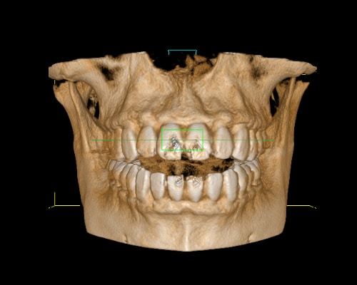 3D Dental CT Imaging