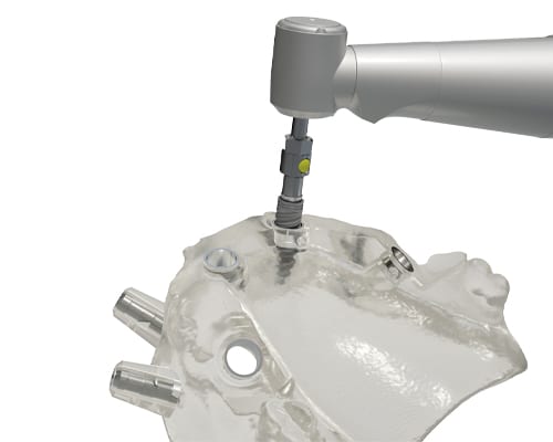 Guided Implant Placement