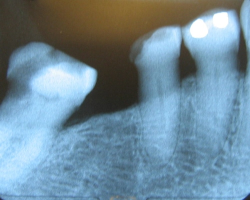 Periodontal (Gum) Disease Therapy